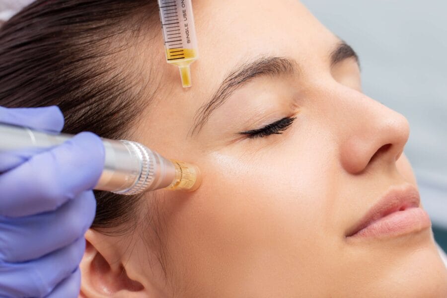 Microneedling Schulung